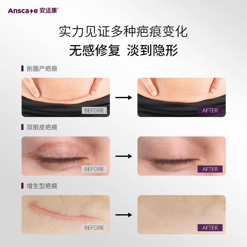 安适康祛疤膏去疤膏增生凸起疤痕膏修复膏儿童除疤手术剖腹产官方