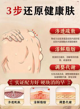 考拉脂肪康膏皮下鼓包硬