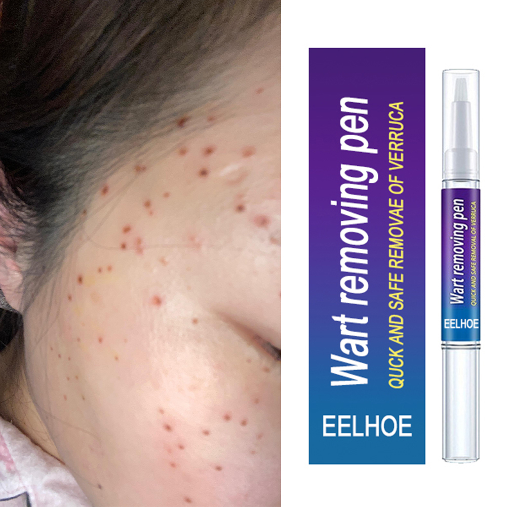 Wart Remover Skin Tag Cream Papillomas Moles Removal-图1