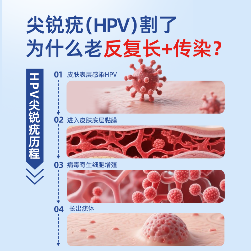 杀灭深层病毒尖锐湿疣专用除私处肛门脖子肉粒疣体喷雾防止复发W - 图0