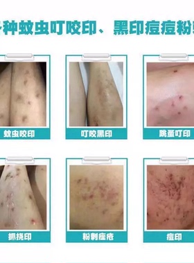 腿上挠印痘印伤烫疤痕蚊虫叮咬黑印淡化黑色素去沉淀去豆疤印消印
