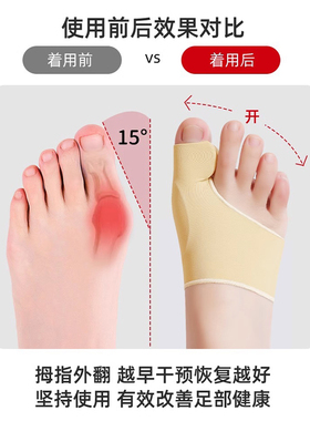 【医生推荐】脚趾矫正器拇指外翻