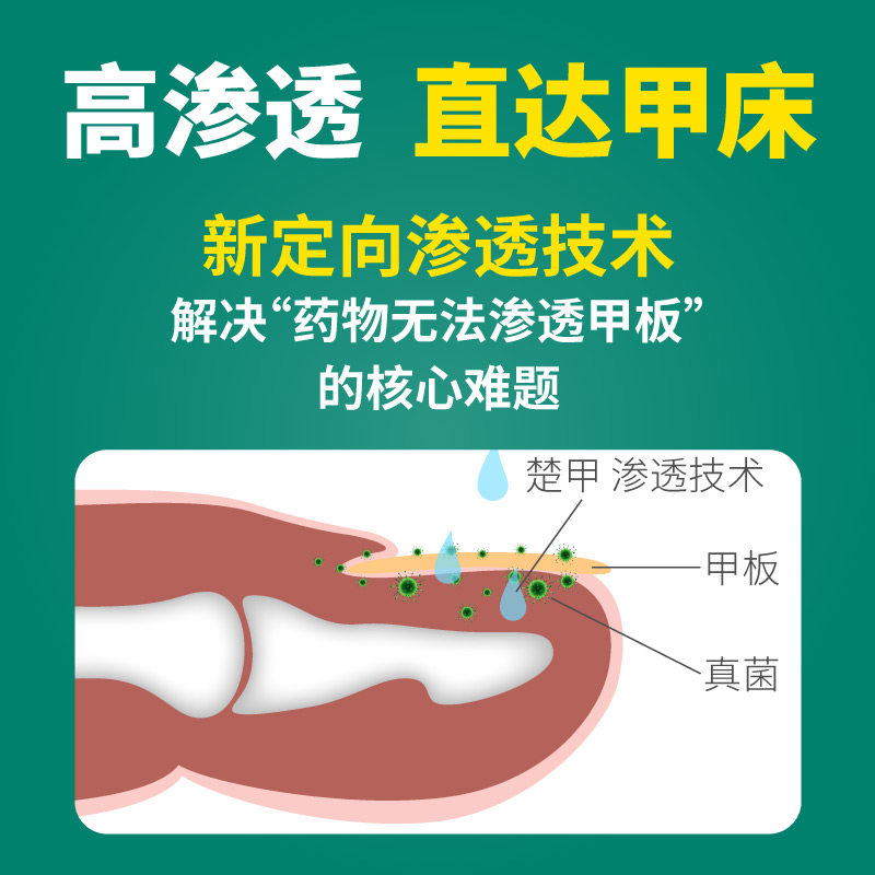 楚甲盐酸阿莫罗芬搽剂2.5 ml甲癣 福邦医药癣症