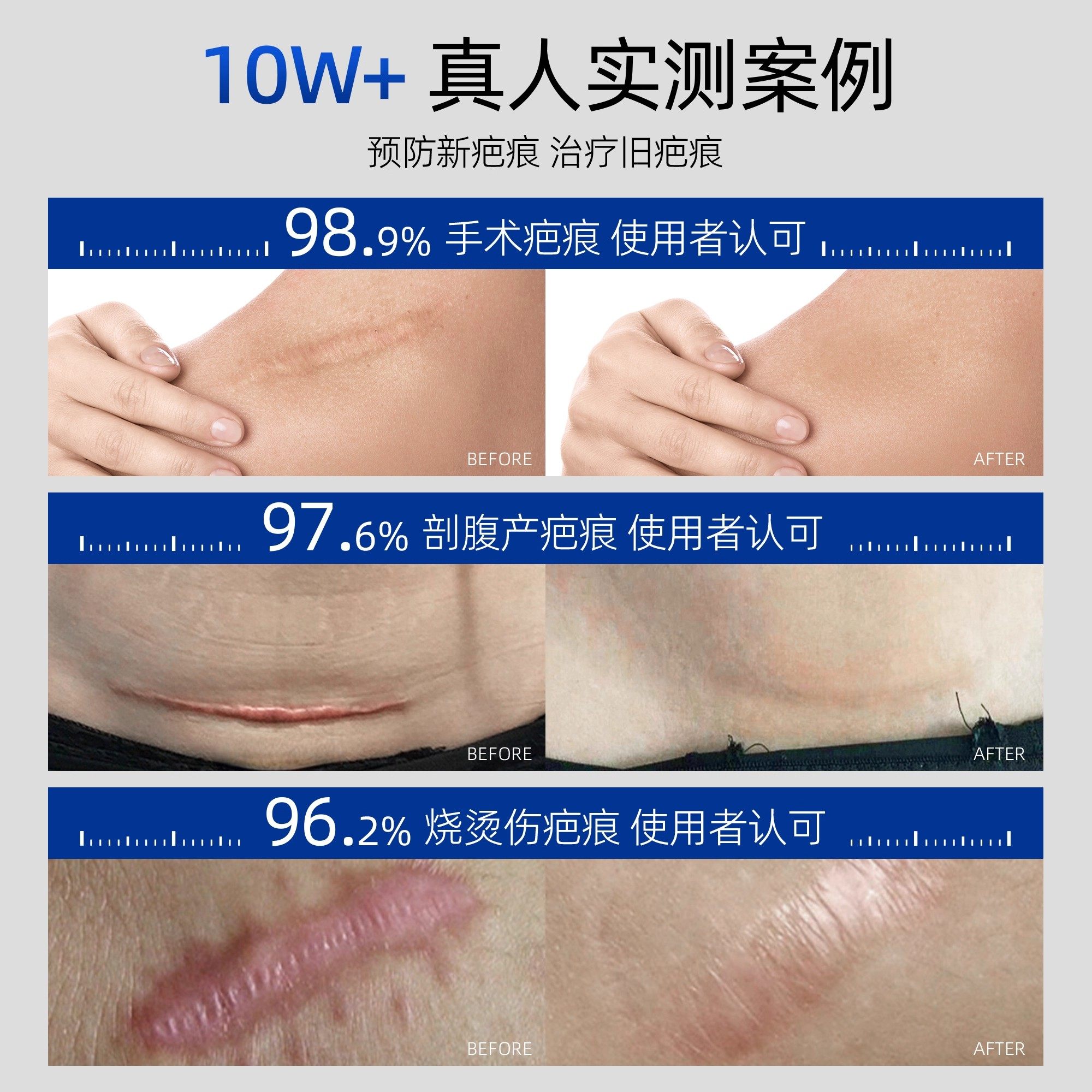 祛疤膏医用硅酮凝胶敷料手术烫伤淡化修复疤痕贴增生凸起除疤产品,淘宝优惠券,粉丝福利购,淘宝优惠卷