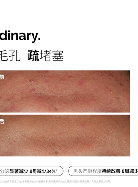【早B晚A】The Ordinary 0.2%视黄醇A醇精华30ml+烟酰胺精华30ml