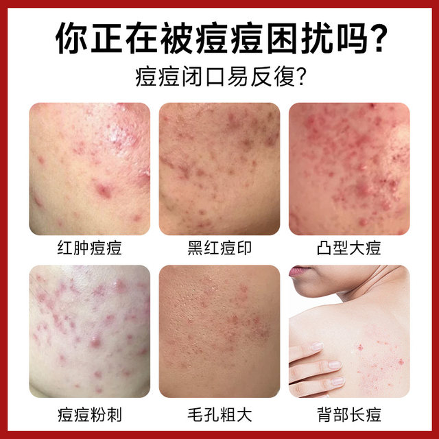 ສະພາບຜິວທີ່ເກີດສິວຈາກພາຍໃນສູ່ພາຍນອກ