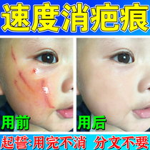 Nail Grip Scars of scar Hyperplasia Repair Cream Surgeries Cream Surgery Raised Children Face Downsides Remove Melanin