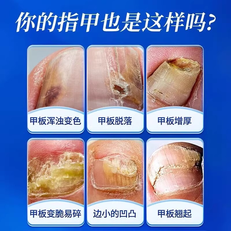 环吡酮胺甲癣灰指甲治疗非特效专用涂剂药水乳膏脱甲正品旗舰店yf - 图1