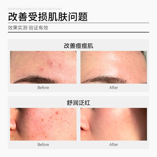 SKLEER姜黄修复凝胶天然皮肤调理激素烂脸脂溢性炎泛红敏感肌临期