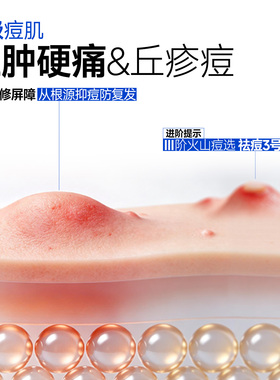 贝芙汀温和祛痘精华凝乳CP套装