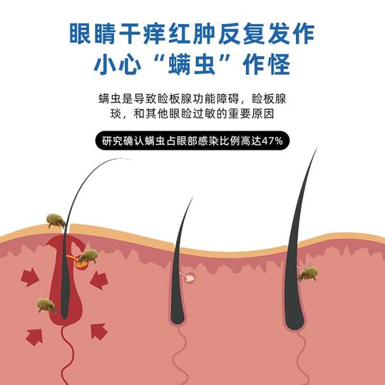 Eye mite removal eye drops, eye wash, itchy eyes, dry eyes, blurred vision, red bloodshot allergies, special