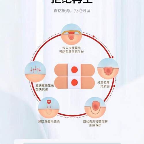鸡眼贴鸡眼膏老茧肉刺肉粒脚丁死皮脚垫趾底手足专用 - 图2