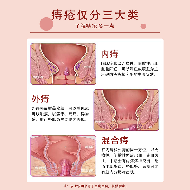 卡波姆痔疮膏医用凝胶便血肛裂内痔外痔混合痔肉球外用官方正品