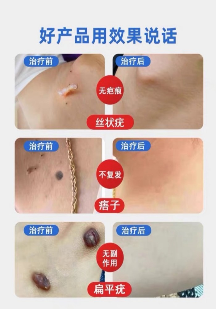 医用液氮去疣神器冷冻治疗刺猴去疣去猴子肉粒疙瘩鱼鳞痣瘊子跖疣_虎窝淘