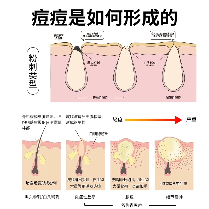 丽芙 甲硝唑凝胶 20克炎症性丘疹酒渣鼻红斑脓疱疮组合阿达帕林W - 图1