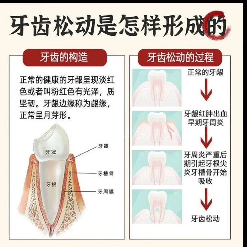 牙齿松动牙龈肿痛萎缩牙痛牙晃动固齿粘合剂治疗牙疼固定器SC - 图0