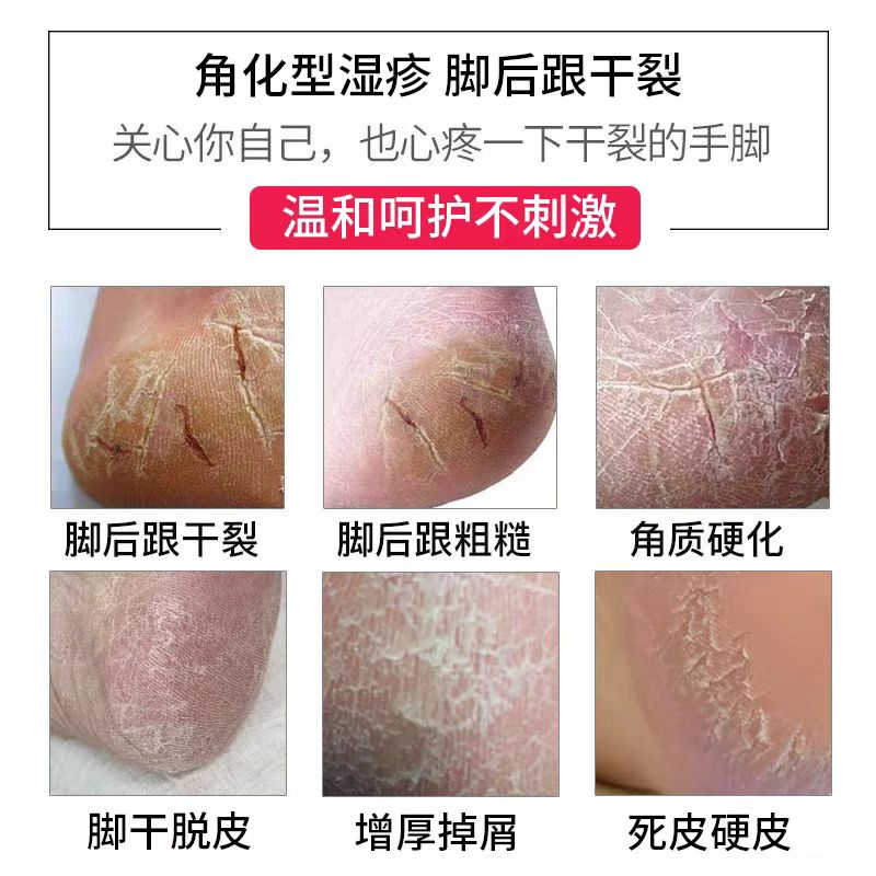 角化型湿疹脚气藤石制软药膏脚后跟干裂起硬皮足跟开裂真菌感染QK - 图0