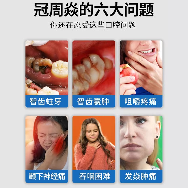 智齿冠周炎智齿牙龈肿痛消炎喷雾药房有售膏牙疼痛牙根发炎上火EK - 图0