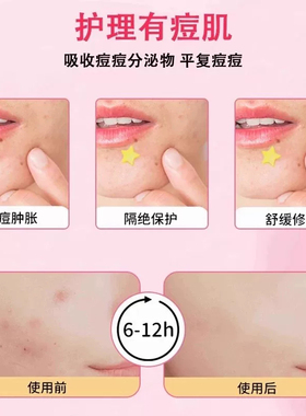 星星痘痘贴痘印贴人工水胶体敷料可上妆可爱豆豆遮瑕痘贴