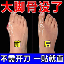 Thumb Valgus (early Good Morning Good) Thumb Valgus Muscle Sticker Big Toe Overlap Joint Swollen Special Effects Patch