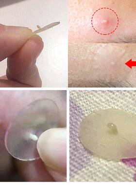 Acne Pimple Patch Stickers Acne Treatment Pimple Remov