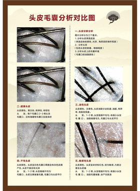 头皮亚健康检测海报展板头皮毛囊分析对比图头皮检测区墙贴墙纸