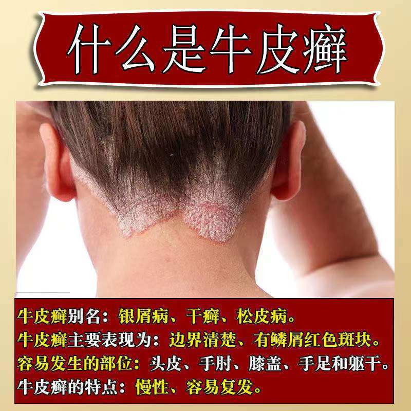  懩生宝大药房癣症