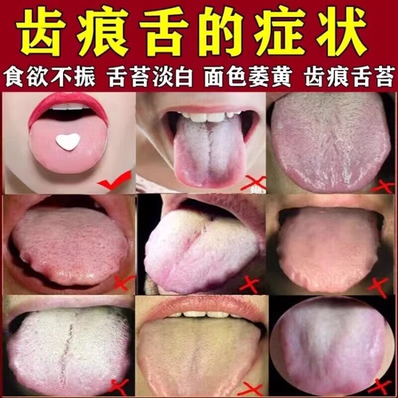 香砂六君丸正品健脾祛湿舌头裂纹齿痕状舌苔黄白厚口臭脾虚湿气重