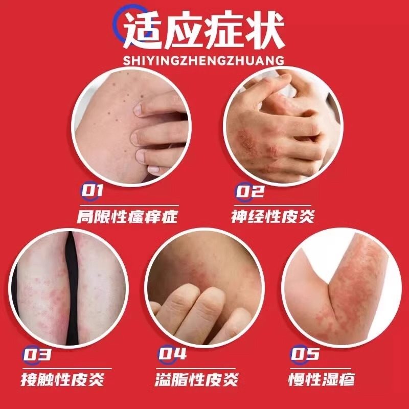 999皮炎平神经性皮炎外用膏治皮肤瘙痒湿疹止痒药过敏瘙痒症药膏,淘宝优惠券,粉丝福利购,淘宝优惠卷