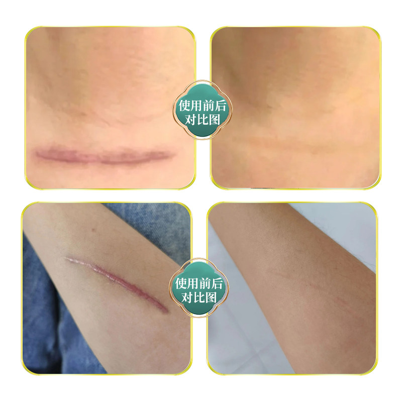 丹参疤痕保健膏香港大药房旗舰店皮肤损伤蚊叮虫咬术后疤痕通用11