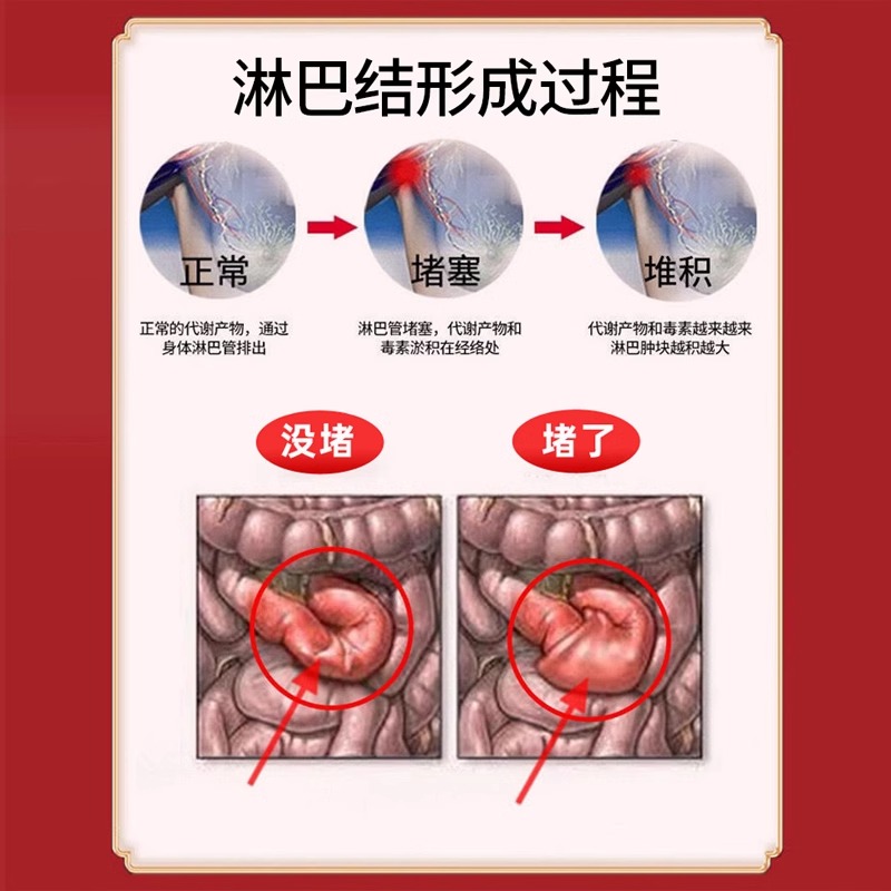 淋巴结肿大散结腹股沟包块脖子特红热痛效消炎疏通可搭配膏药贴VT