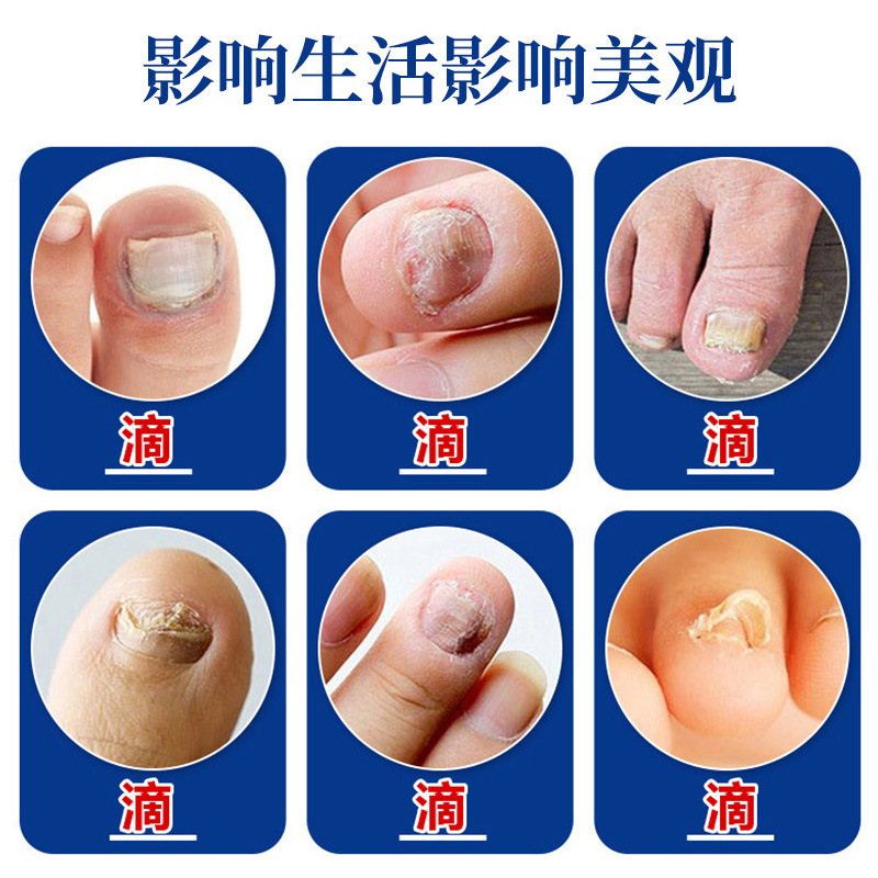 灰指甲沟炎专用特效抑菌液趾指甲膏护理保健液真菌感染正品旗舰店
