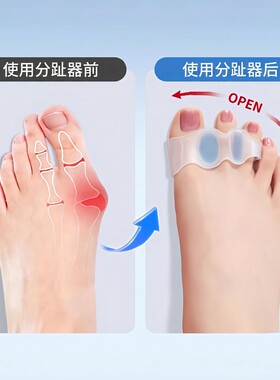 无痛矫正】男女通用丨拇指矫正器