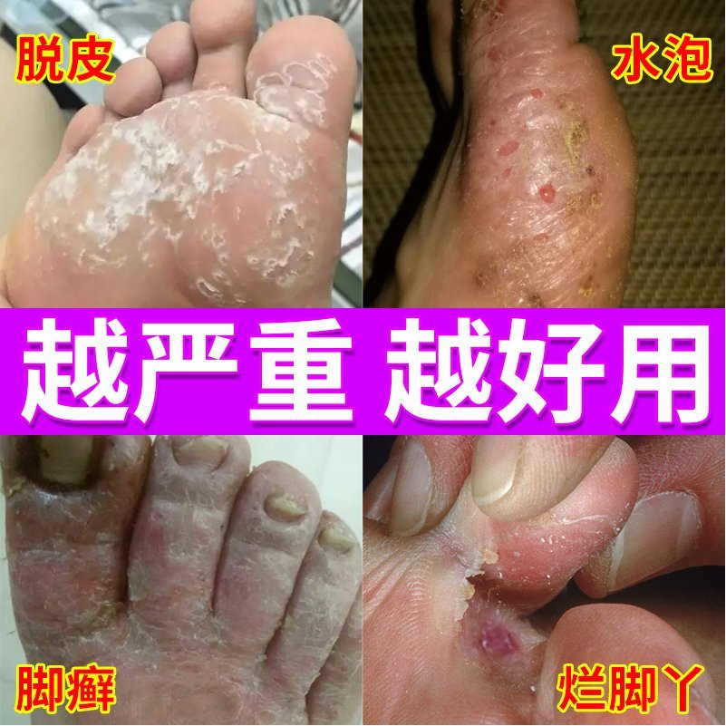 脚气烂脚丫药脱皮糜烂脚趾缝烂痒治疗水泡真菌感染止痒神器-图0