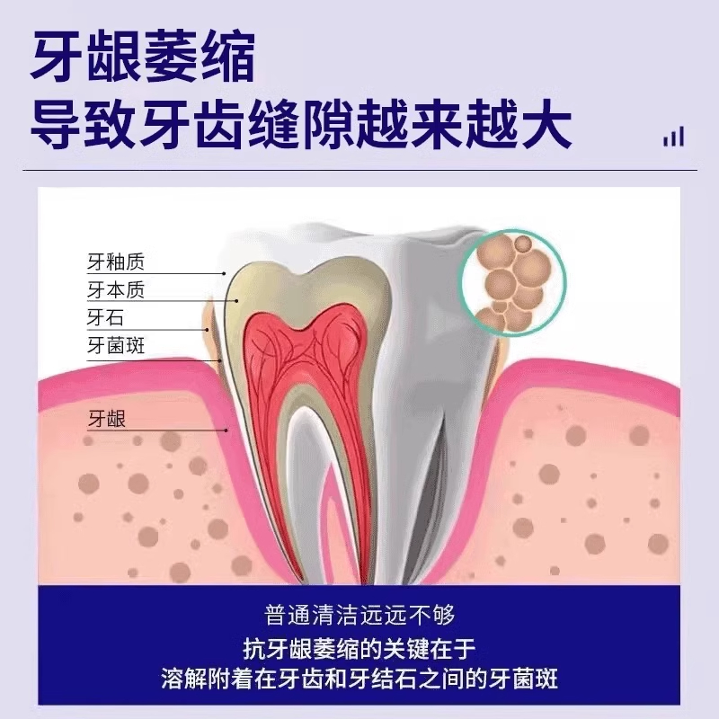 牙缝宽大牙齿敏感导致牙龈萎缩可搭牙膏牙疼牙龈萎缩修松动FJ - 图1