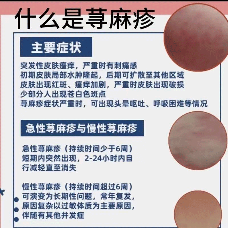 丘疹性荨麻疹膏过敏止痒皮肤瘙痒急性特提高效免疫力医用&正品VG,淘宝优惠券,粉丝福利购,淘宝优惠卷