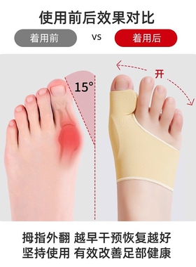 拇指外翻矫正器脚趾大脚骨矫正
