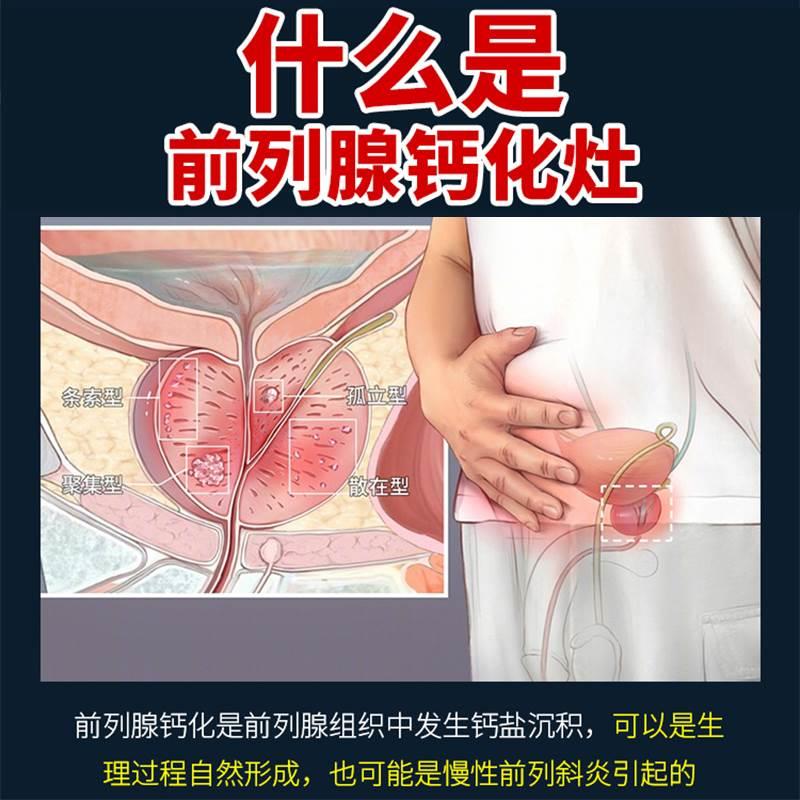 日本前列腺钙化灶专用慢性前列腺炎特效增生肥大男性调理膏贴ZZ