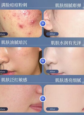 正品水杨梅控油祛痘面膜补水保湿提亮肤色收缩毛孔淡化细纹男女