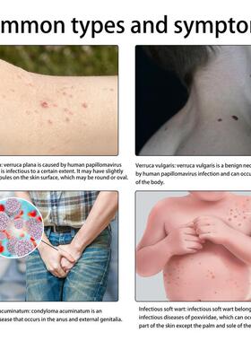 好货Wart Remover Liquid Effective Removal Of Flat Warts Reme