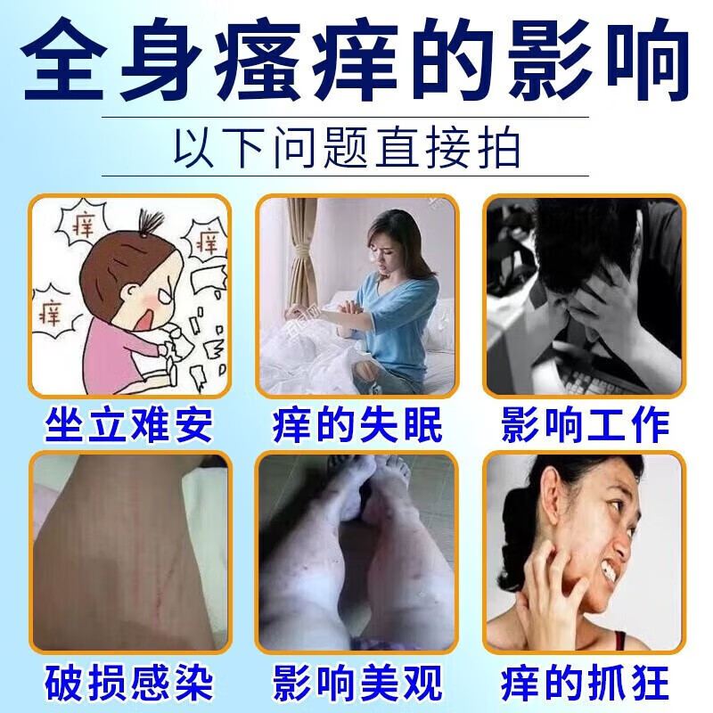 治皮肤瘙痒过敏止痒药膏真菌感染皮炎湿疹皮癣身上起红疙瘩红点痒 - 图2