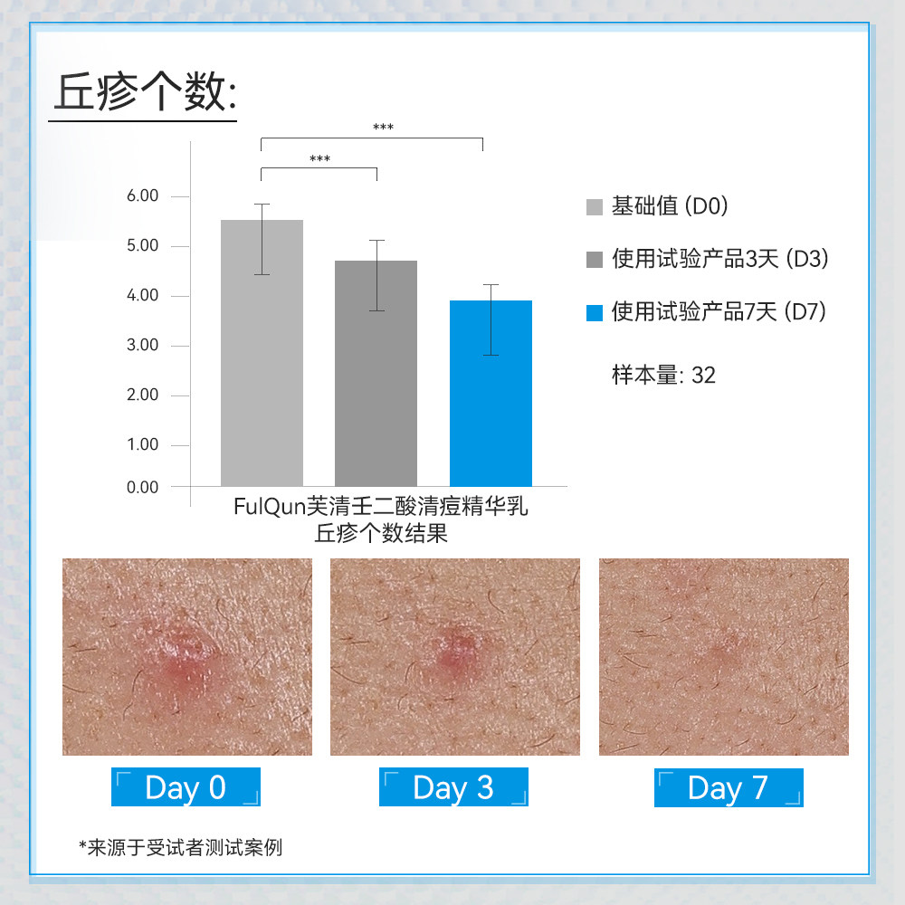 芙清壬二酸20%清痘凝胶精华水杨酸控油淡化祛痘印痘痘闭口粉刺,淘宝优惠券,粉丝福利购,淘宝优惠卷
