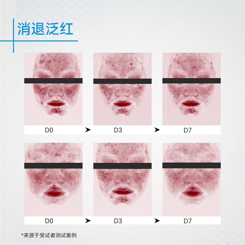 芙清壬二酸20%清痘凝胶精华水杨酸控油淡化祛痘印痘痘闭口粉刺,淘宝优惠券,粉丝福利购,淘宝优惠卷