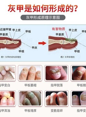 好货坏指甲增厚手脚趾甲黄黑白空甲修复甲分离空心发黄变厚康甲亮