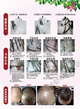 头皮检测对比图海报检测图头疗图片宣传画分析图毛囊对比图对照表