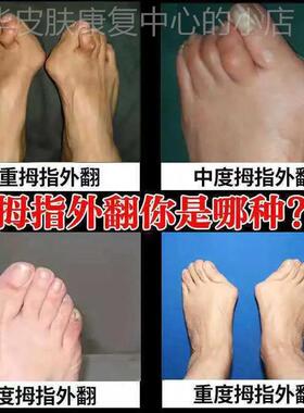 速发【修晚矫正】拇指外翻矫正器大脚骨变形脚趾重叠专用贴当复神