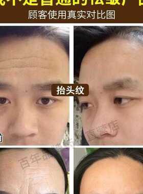 皱纹抬头纹额头纹川字纹法令纹祛皱女男士专用去除提拉紧致神器