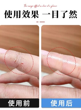 【手指防裂贴】防进水受伤手指头保护套透明防磨自粘指套防开裂贴