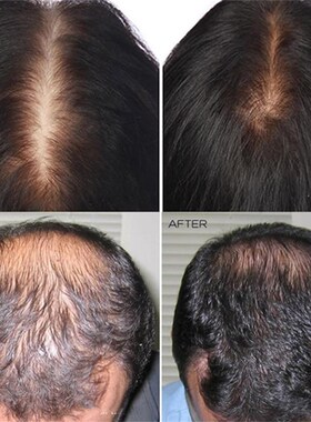 好货Ginger Hair Growth Spray Scalp Hair Loss Treatment Baldn