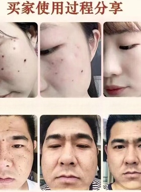 美容院同款官方正品古方植物点痣膏祛痣去候痦脂肪粒黑点不留疤痕